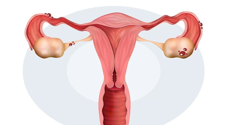 Endometriosis