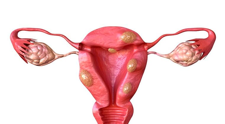 Fibromas uterinos (miomas)