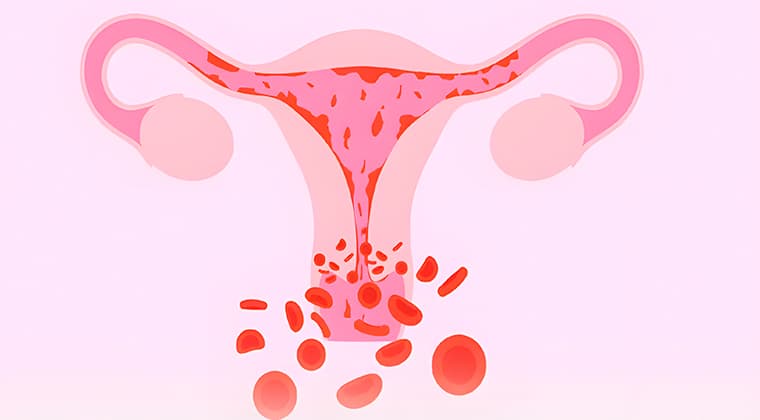 Sangrado uterino anormal