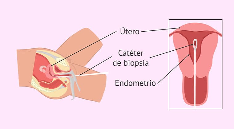 Biopsia de endometrio