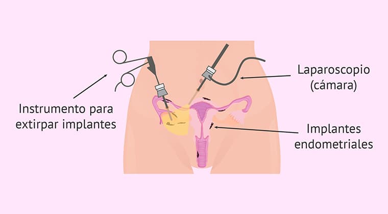 Cirugía para endometriosis