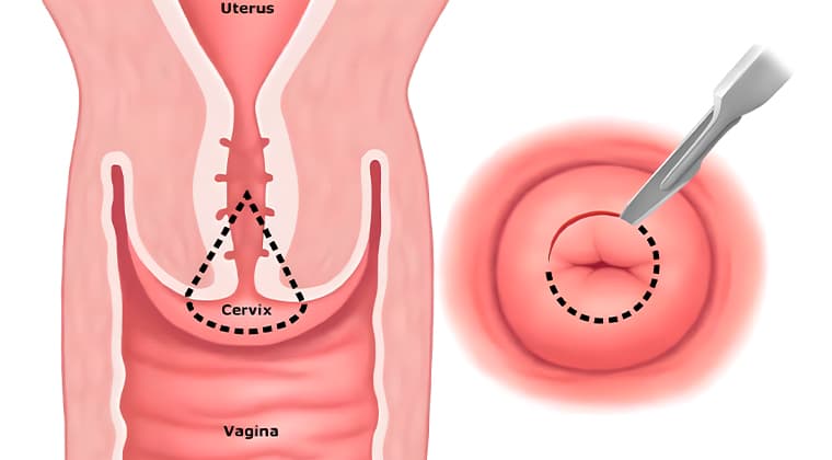 Conización cervical