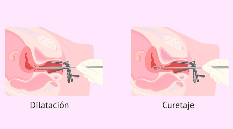 Dilatación y curetaje