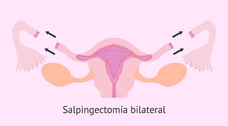 Salpingectomía
