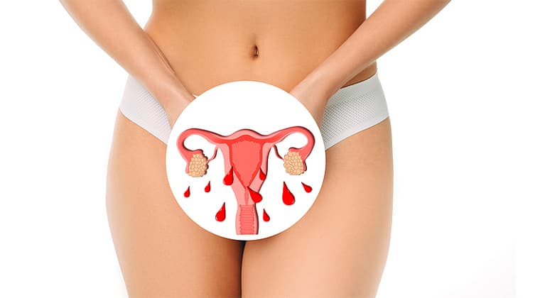 Sangrado menstrual abundante
